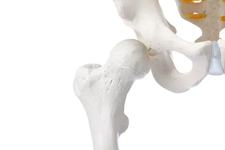 Rehabilitacija po operaciji kolka - menjava kolka