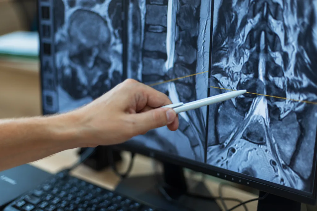 MR slikanje hrbtenice za postavitev diagnoze hernije diska.